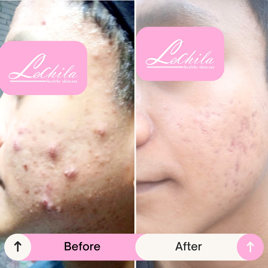 testi acne focus (1)